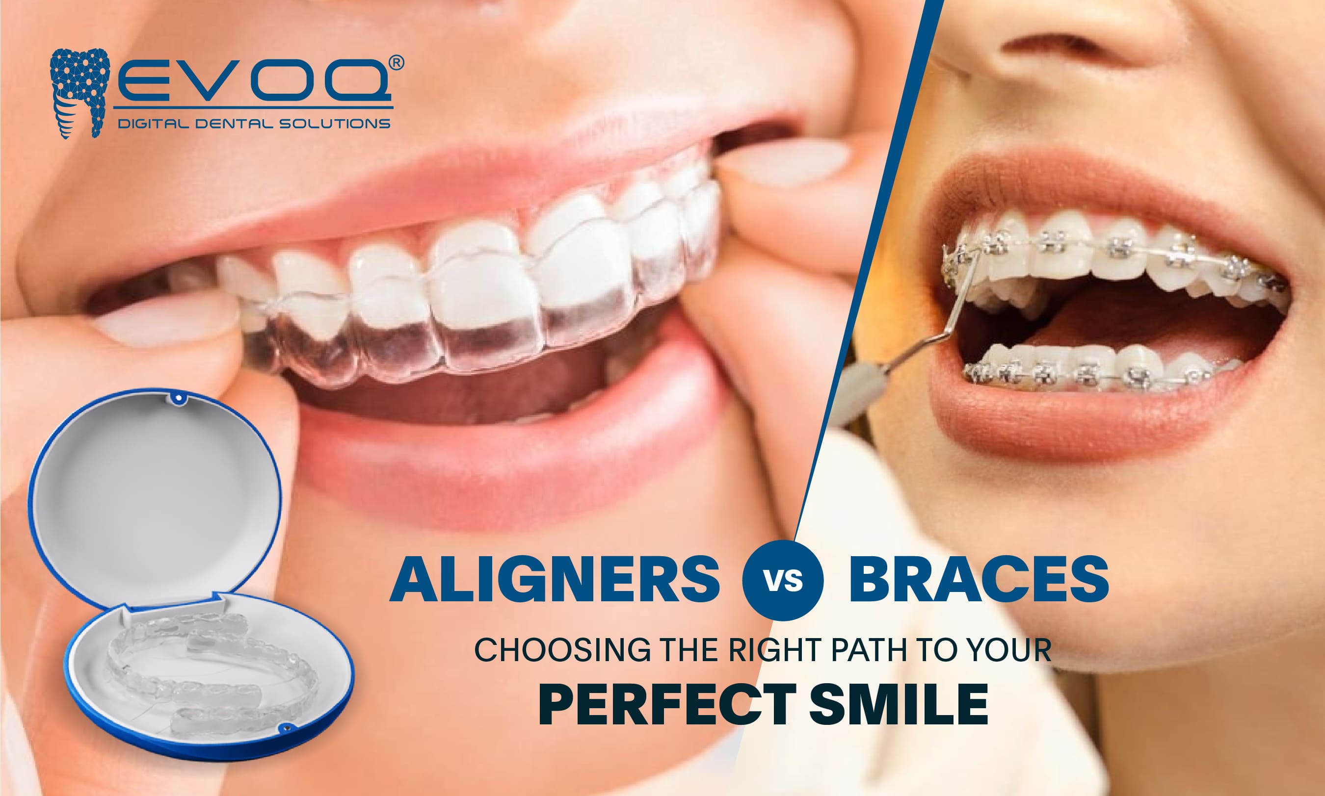 Aligner Treatment vs Braces: Choosing the Right Path to Your Perfect Smile