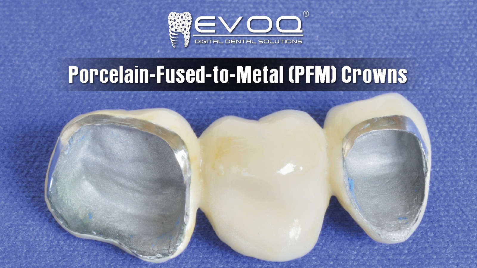 Porcelain-Fused-to-Metal (PFM) Crowns: Advantages and Disadvantages